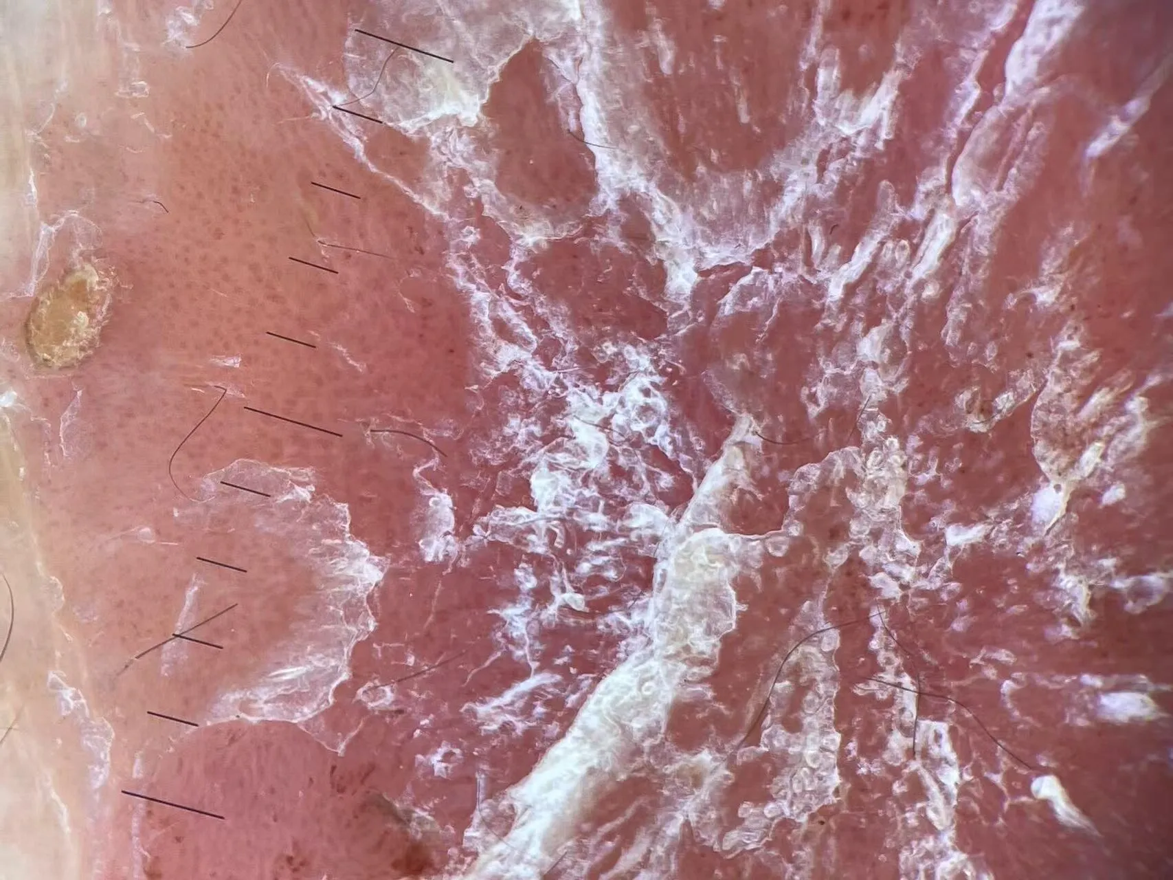 DE-500 dermatoscope effect