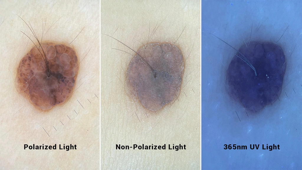 
IBOOLO Phone Dermatoscope Effect