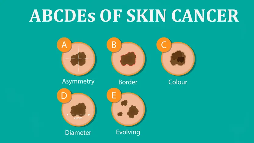 ABCDEs of Skin Cancer