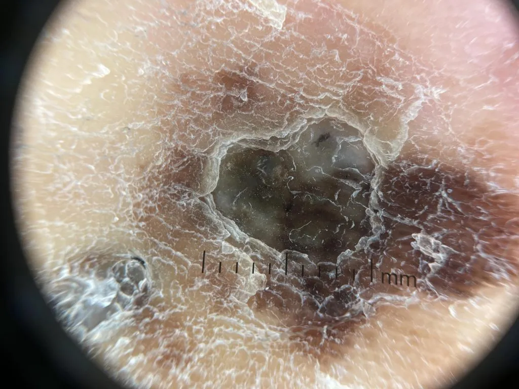 Melanoma IBOOLO