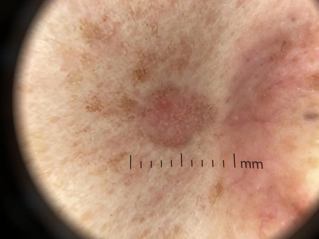 Actinic Keratosis IBOOLO