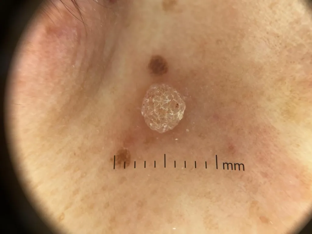 Common wart IBOOLO