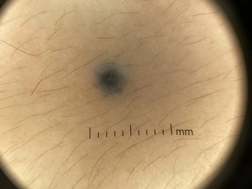 blue nevus IBOOLO