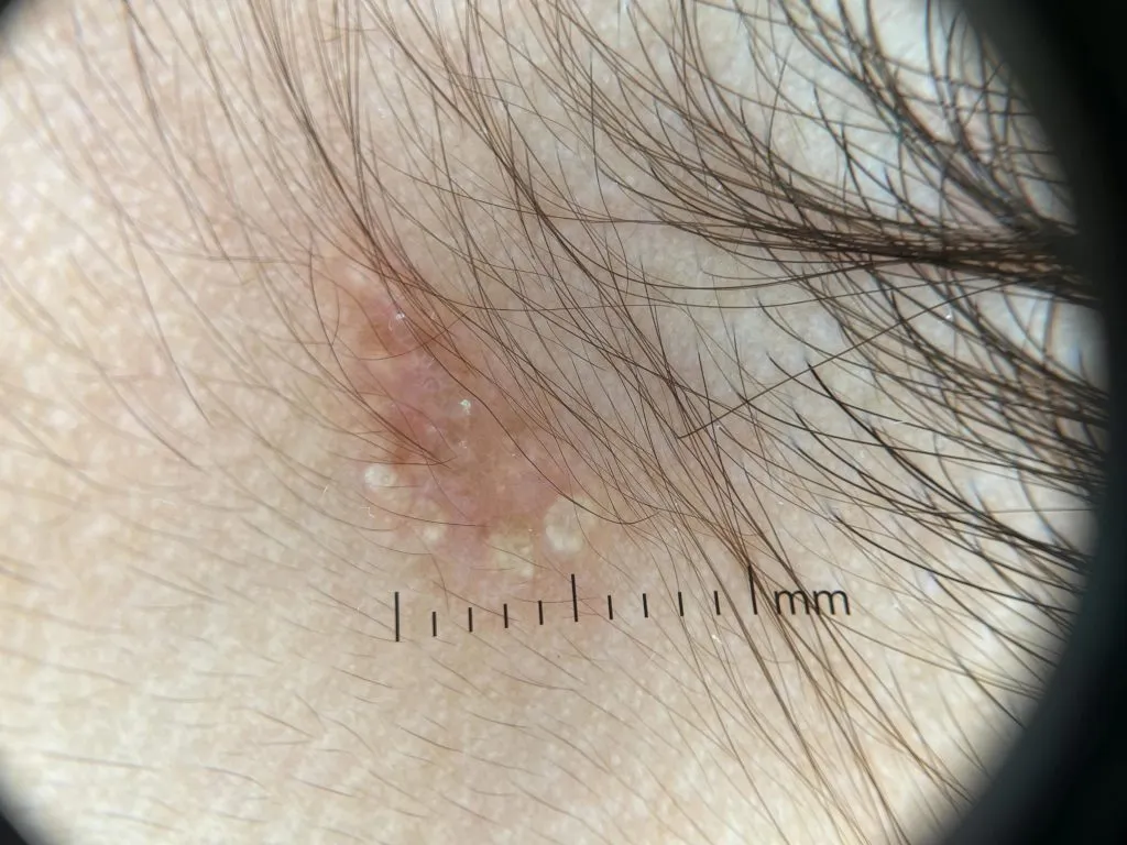 sebaceous nevus IBOOLO