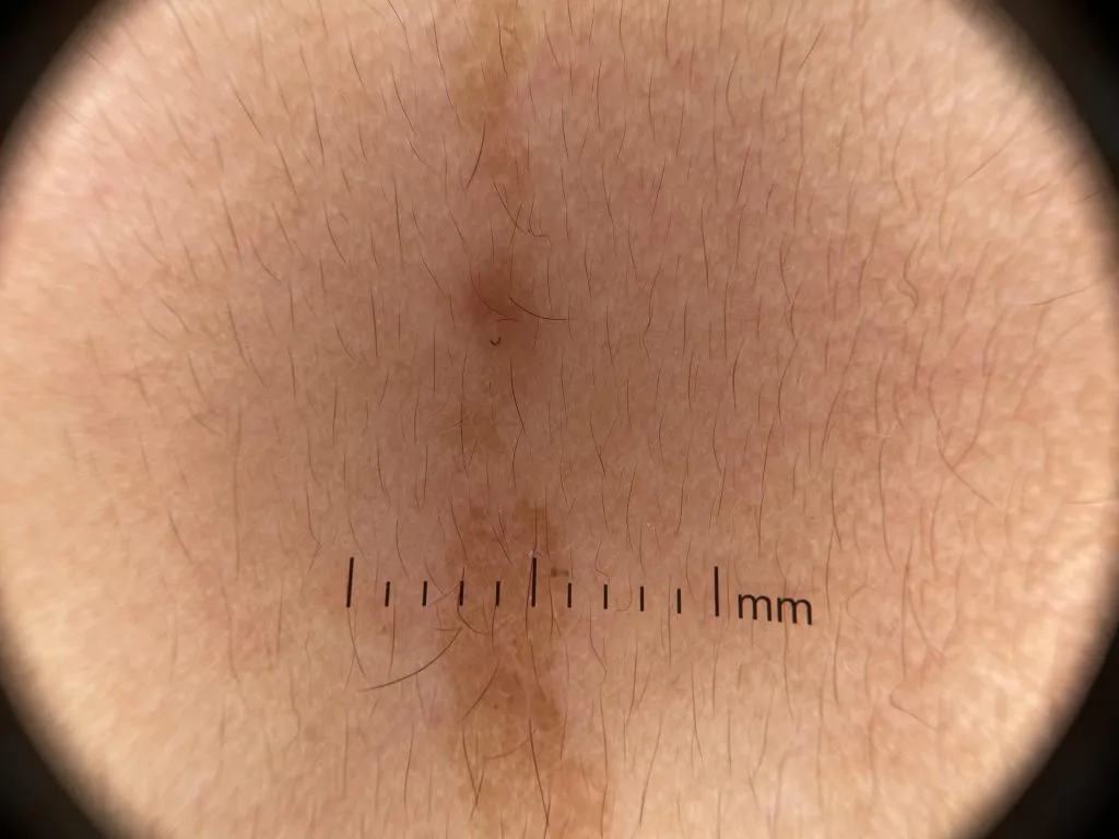 verrucous epidermal nevus IBOOLO