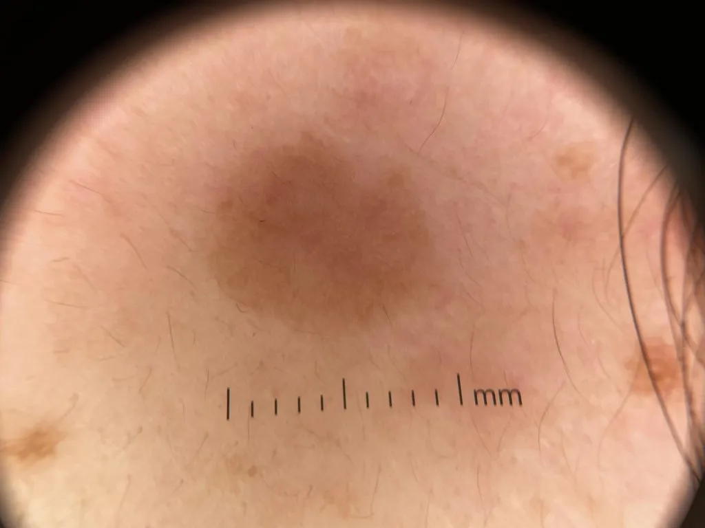 Seborrheic keratosis IBOOLO