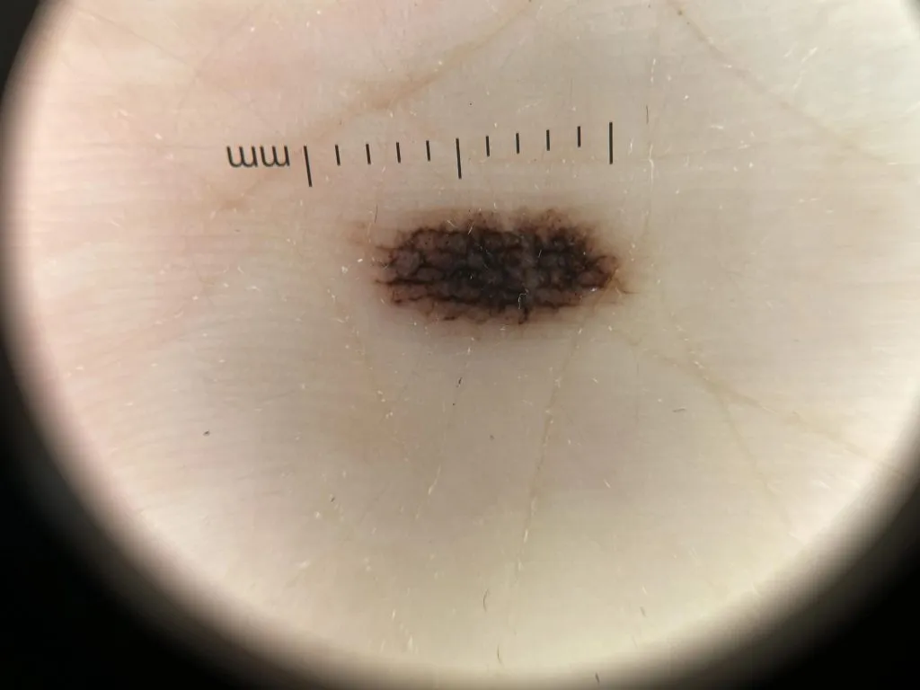 acral junctional nevus IBOOLO
