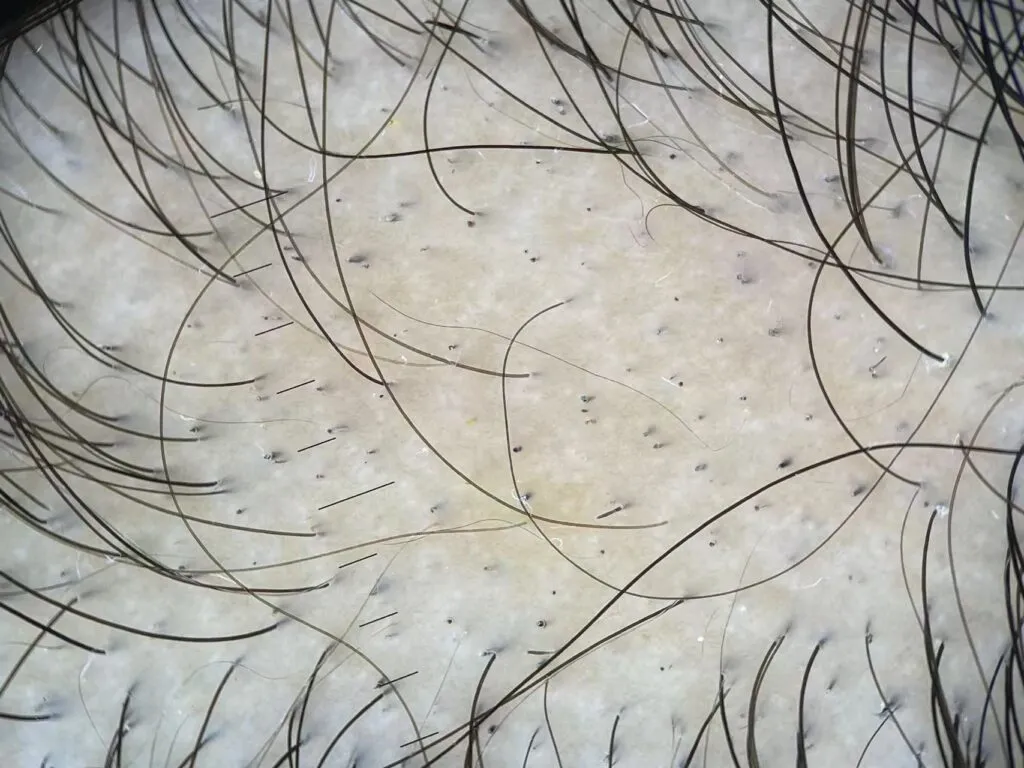Alopecia areata IBOOLO DE-500 Dermatoscope