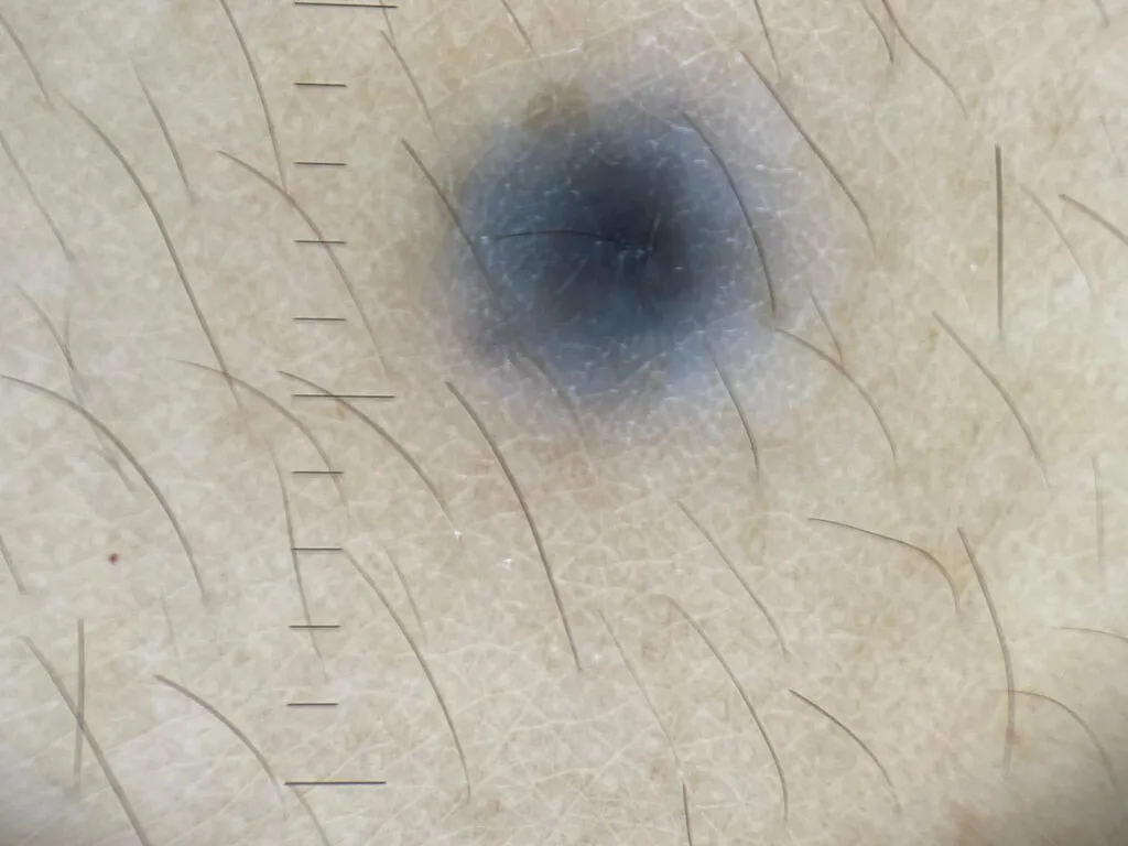 Blue Nevus IBOOLO DE-500 Dermatoscope