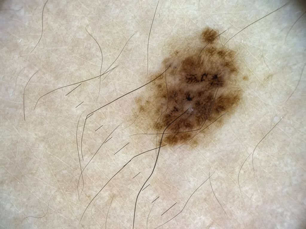 Congenital Melanocytic Nevus IBOOLO DE-500 Dermatoscope