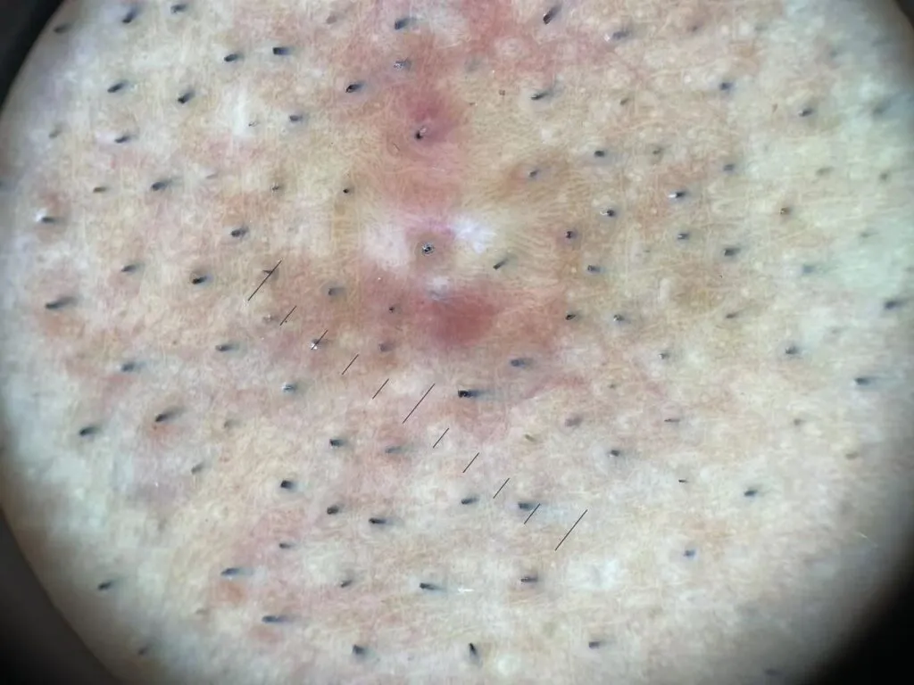 Epidermoid Cyst IBOOLO DE-500 Dermatoscope