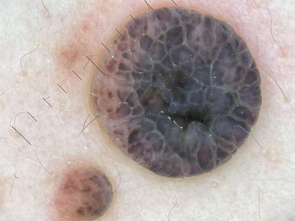 Intradermal Nevus