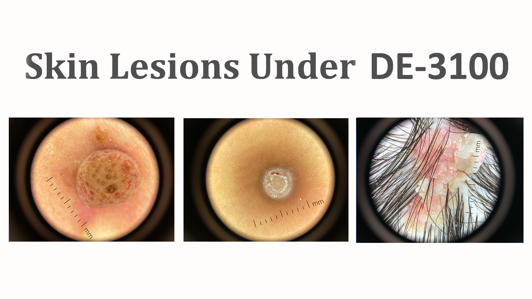 IBOOLO DE-3100 皮膚鏡下の皮膚病変 – IBOOLO
