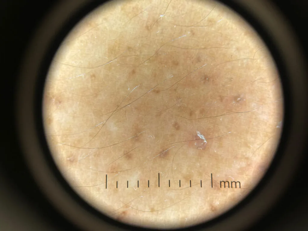 Cutaneous amyloidosis