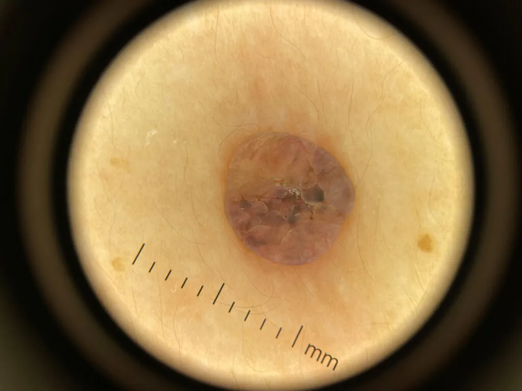 Seborrheic keratosis