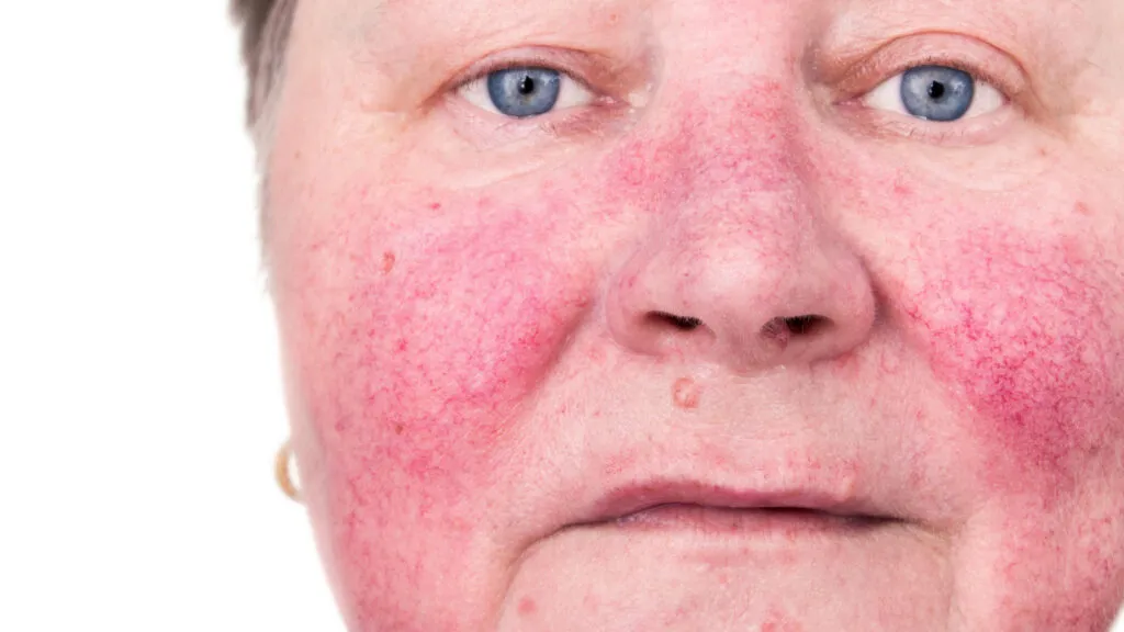 Rosacea 1