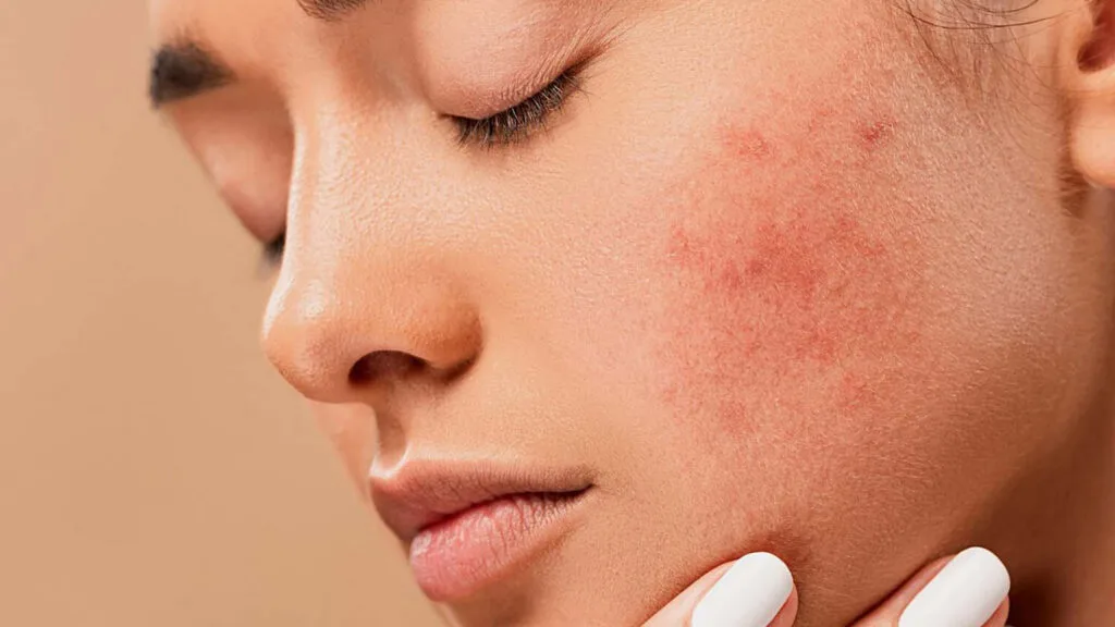 acne 2