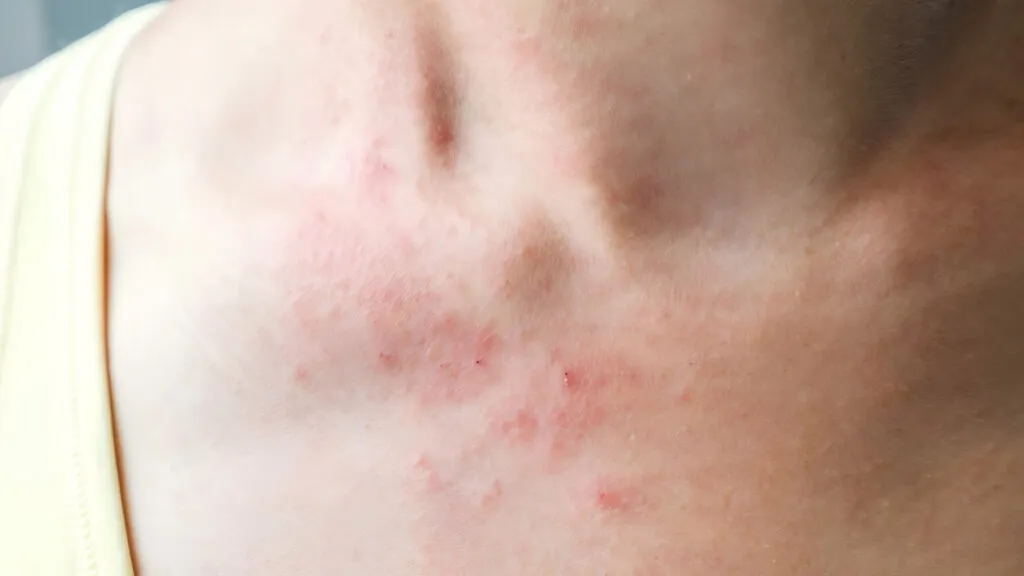 Eczema 1