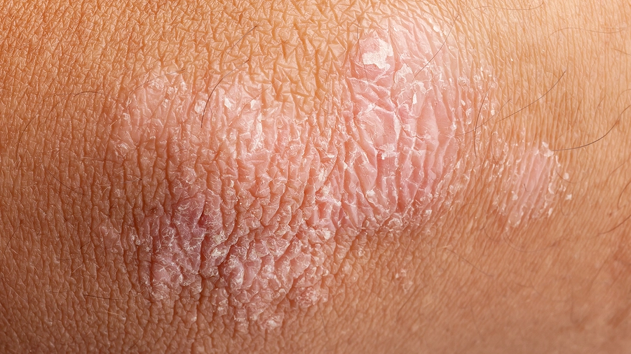 xerosis
