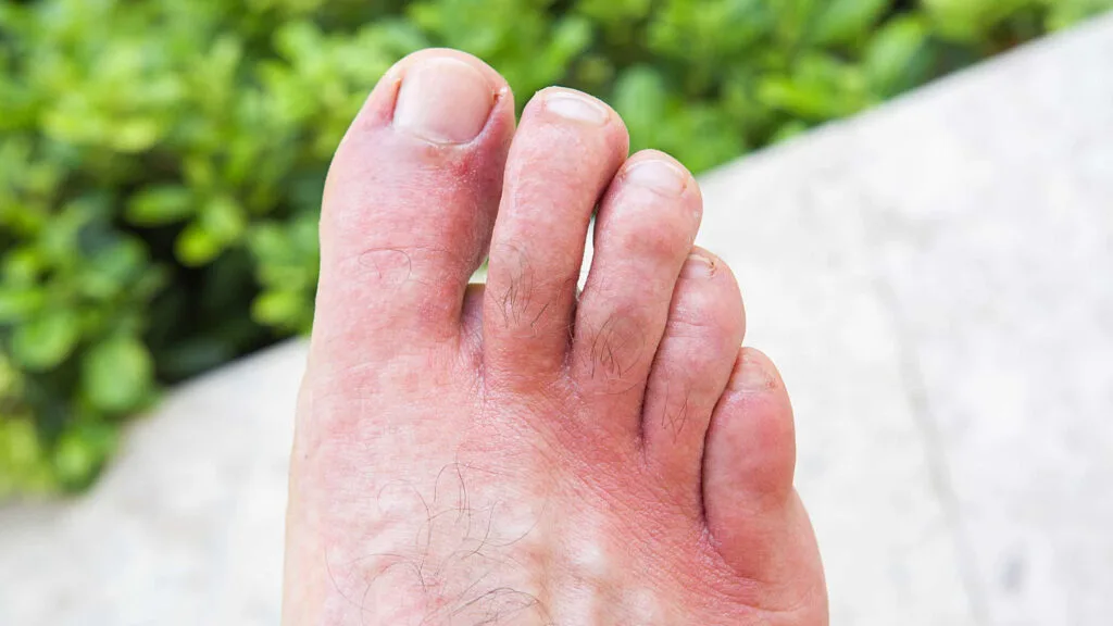 chilblains2