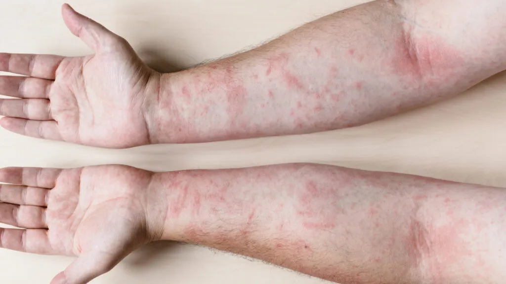 Allergic Contact Dermatitis