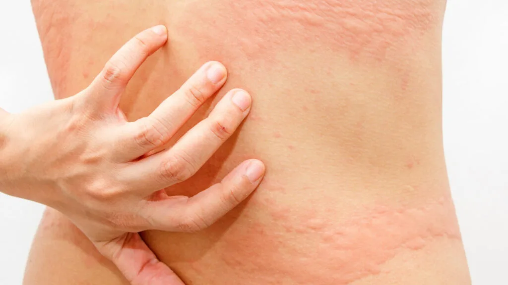 Urticaria