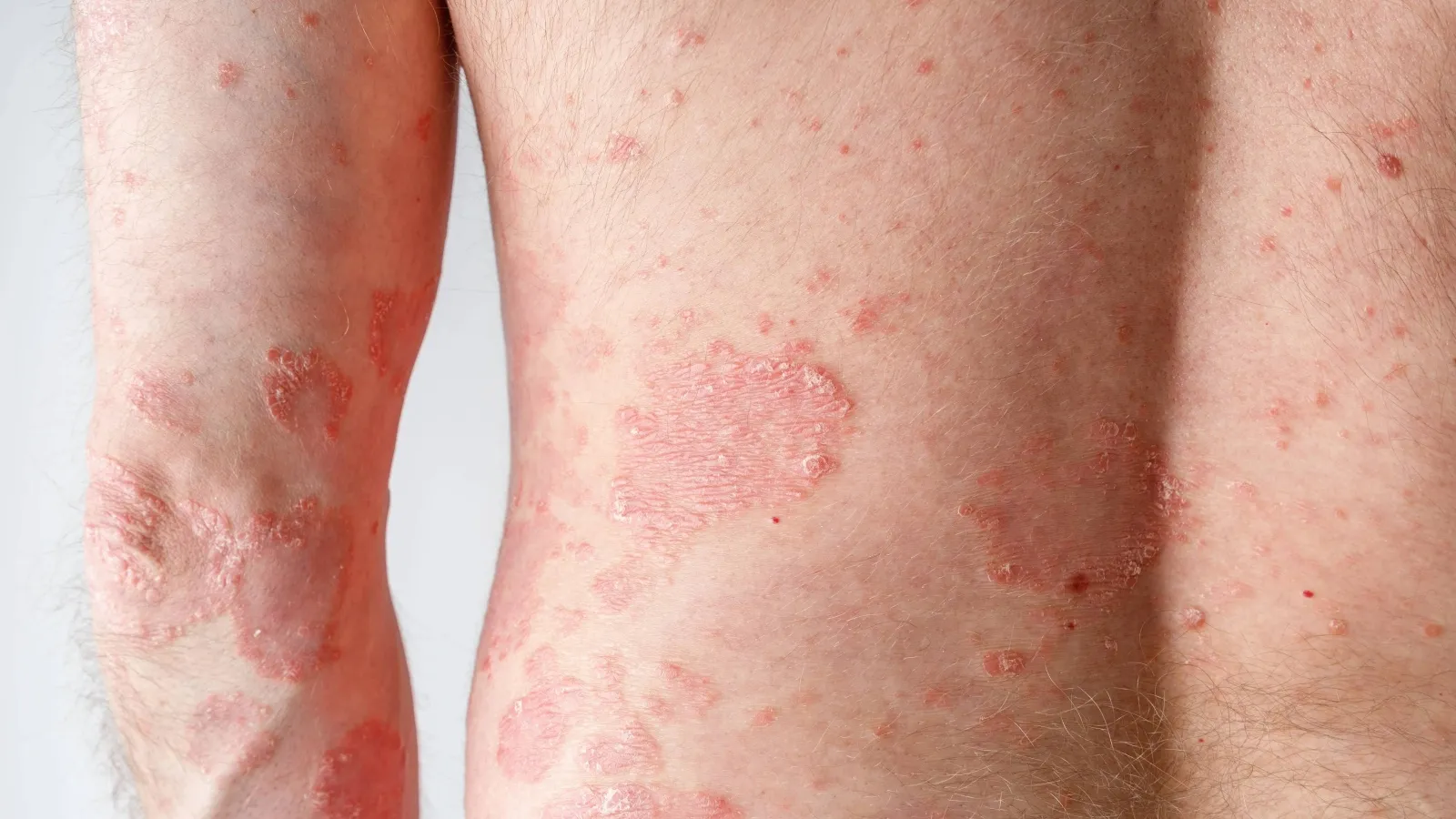 Pityriasis Rosea