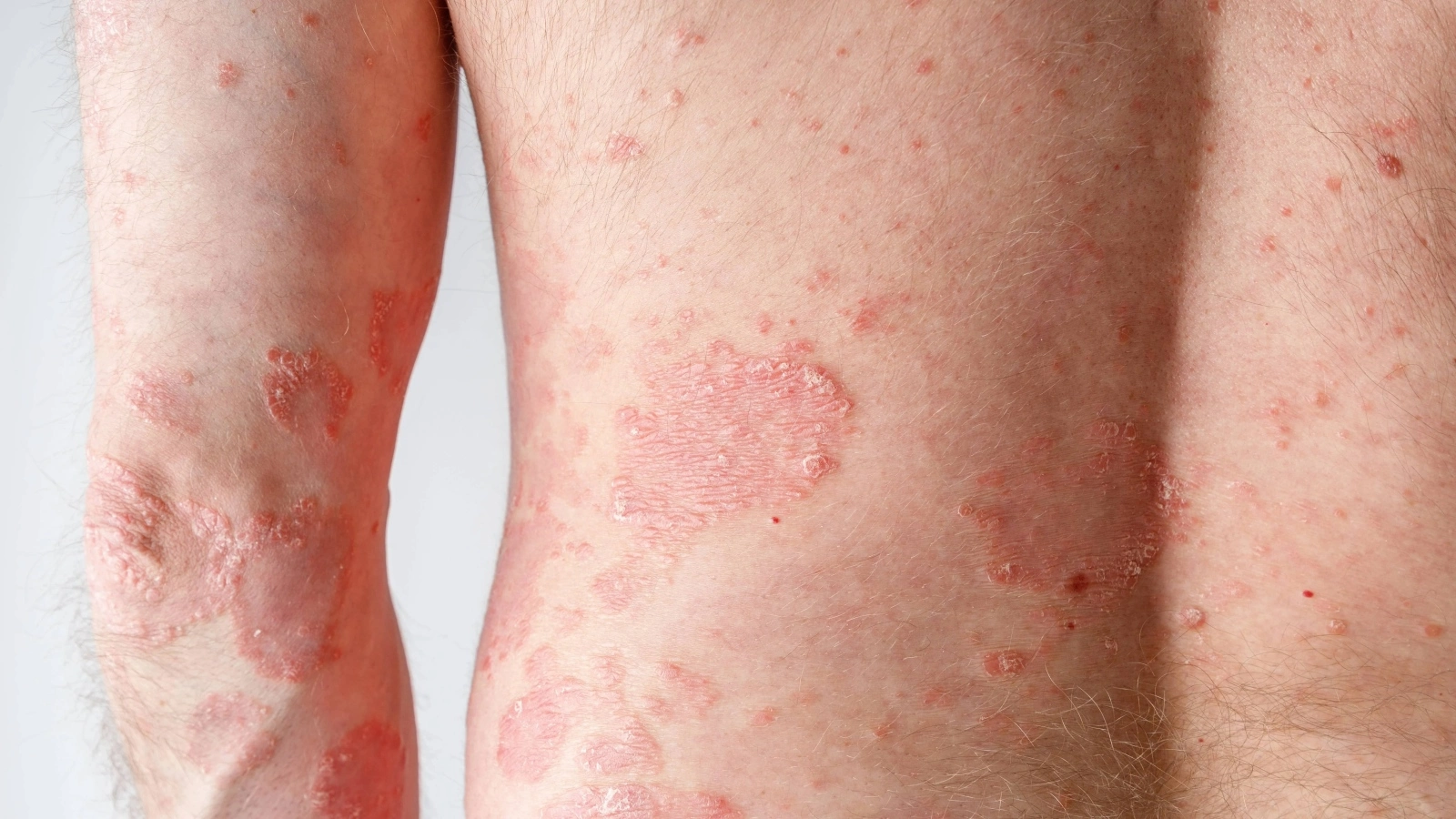 Pityriasis Rosea