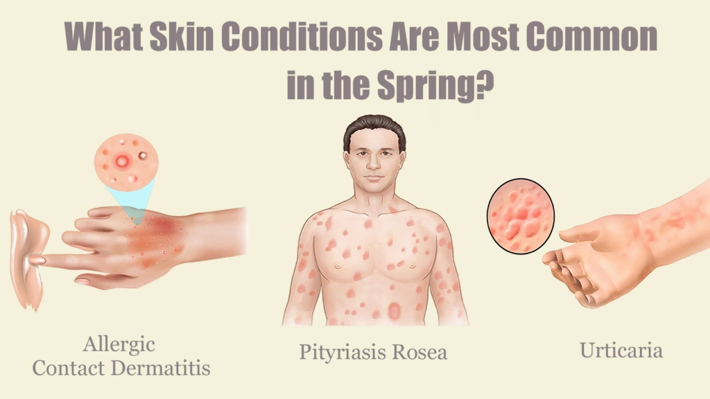 skin conditions in the spring cover