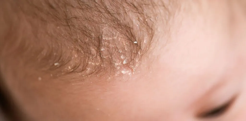 Seborrheic Dermatitis