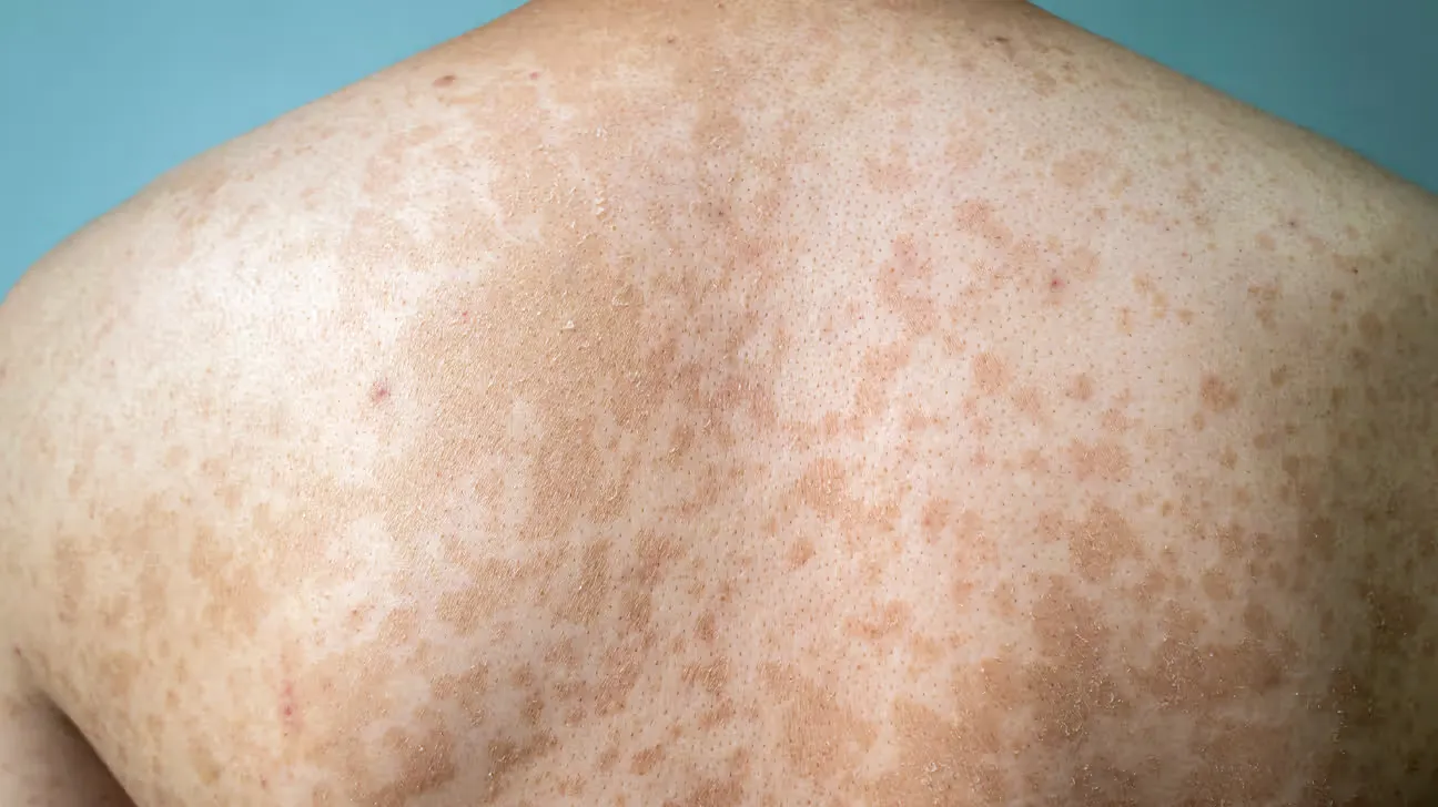 pityriasis versicolor1