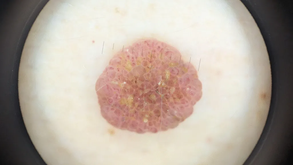 IBOOLO DE-500 Intradermal nevus