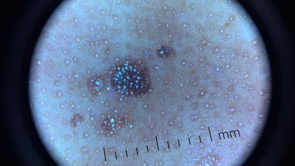 Seborrheic Keratosis UV