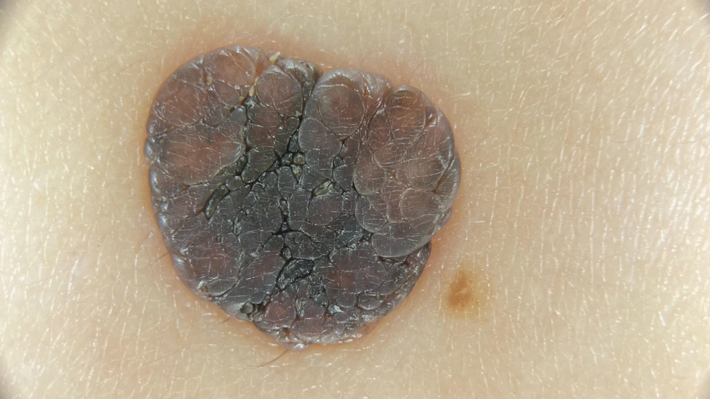 Seborrheic Keratosis under IBOOLO DE-3100 PRO Non-polarized Effect
