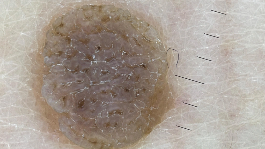 Seborrheic Keratosis DE-500 dermatoscope