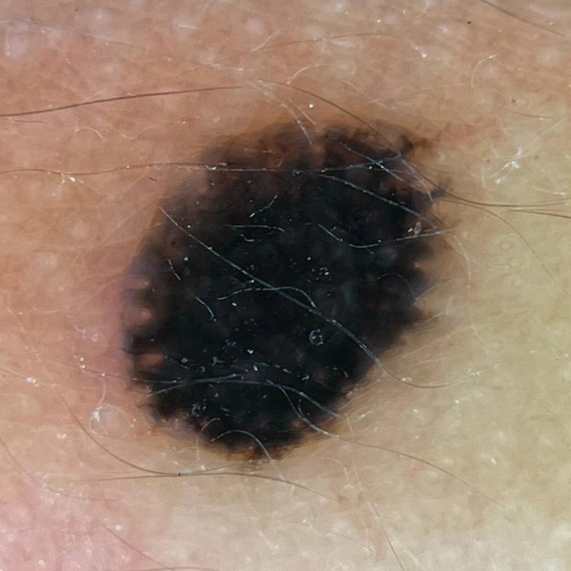 Pigmented Lesions