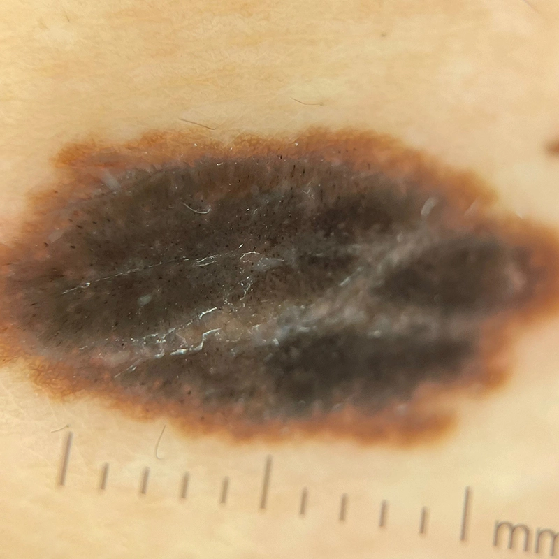 Suspicious Pigmented Lesions