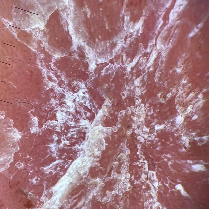 Psoriasis Assessment