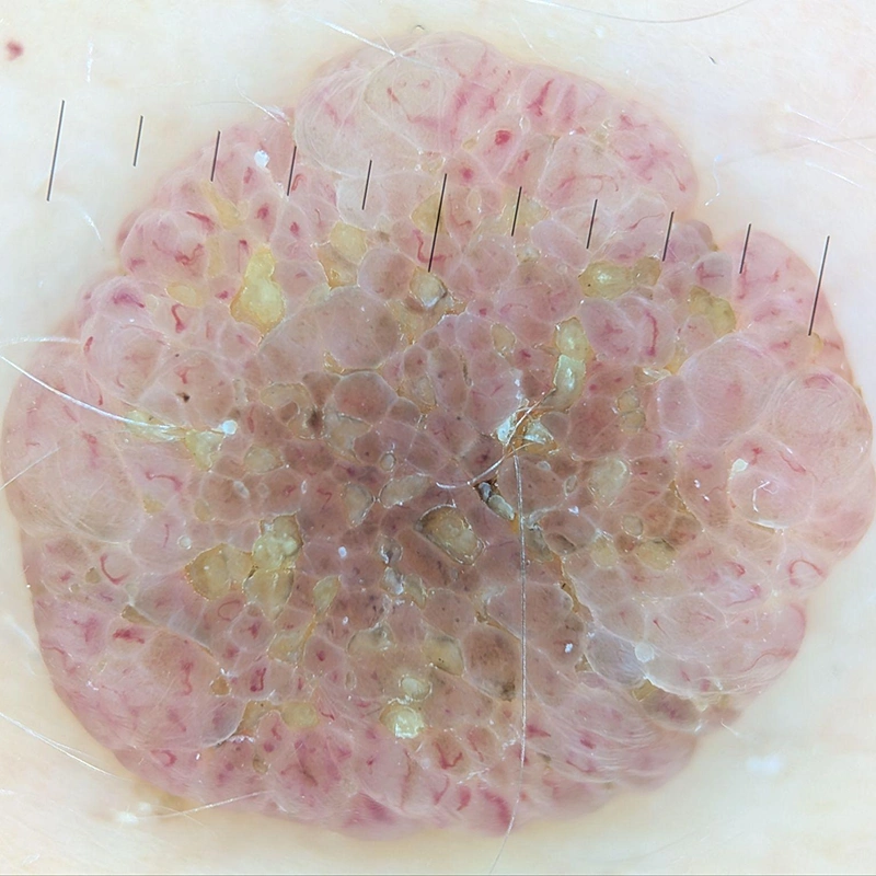 Benign Nevus Examination