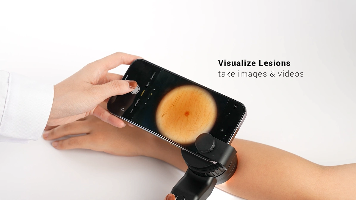 iboolo dermatoscope photo saving